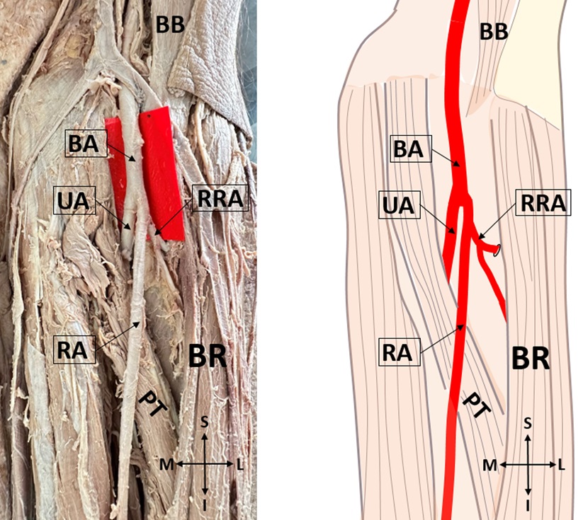 Figure  1.  Radial  recurrent  artery  originating  from  the  radial artery