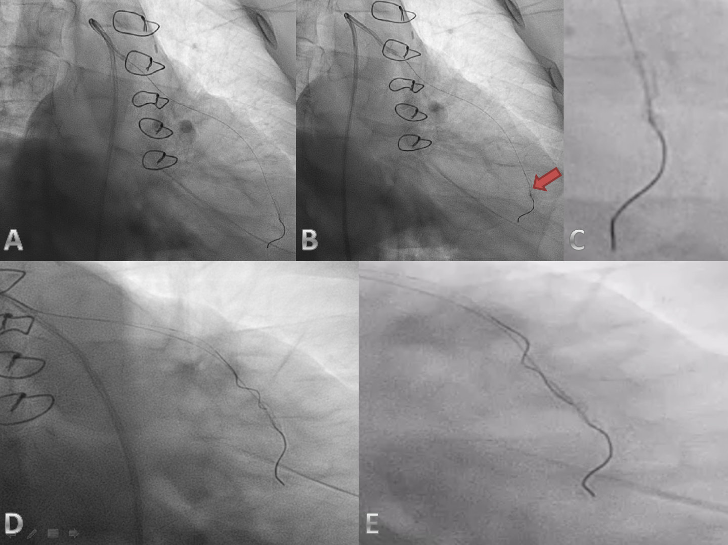 Figure 1. A: First image after transfer, B: Deformed stent view marked with red arrow, C: Zoomed image of deformed stent, D: Failure to send the second guide wire, E: Failure to send the second guide wire zoomed in