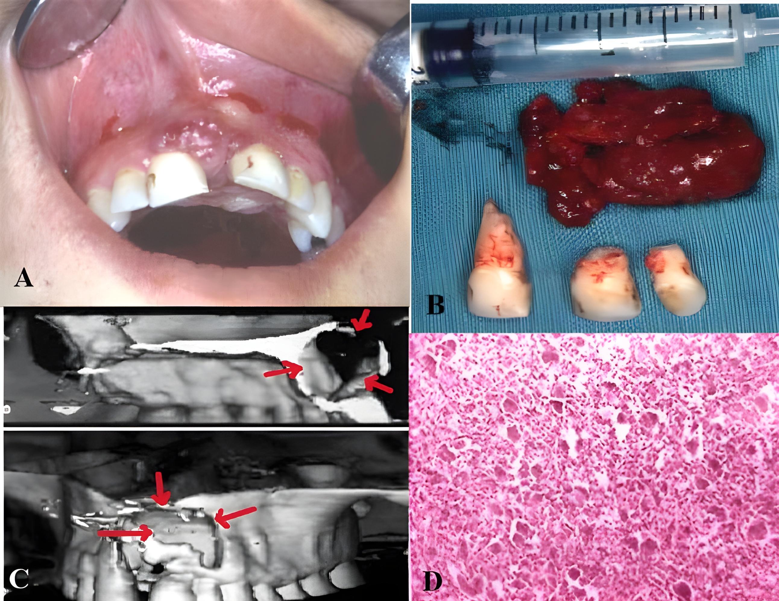 Figure 1. Clinical, Radiological, Surgical, and Histopathological Findings of a Central Giant Cell Granuloma Located in the Anterior Maxillary Region A: Intraoral clinical view of a well-defined radiolucent lesion located in the anterior maxilla. B: Post-surgical appearance following excision of the lesion and extraction of the adjacent teeth. C: Three-dimensional computed tomography image of the maxilla within the craniofacial skeleton. D: Histopathological image showing multinucleated giant cells situated within a vascularized fibrous connective tissue containing numerous hemorrhagic foci and hemosiderin pigment.